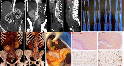 Case Report: Evolution of a Severe Vascular Refractory Form of ECD Requiring Liver Transplantation Correlated With the Change in the Monocyte Subset Analysis